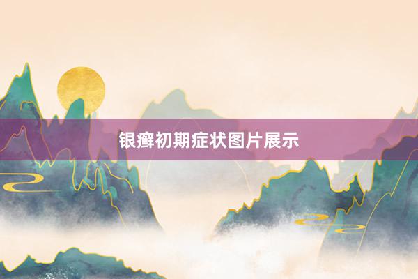 银癣初期症状图片展示